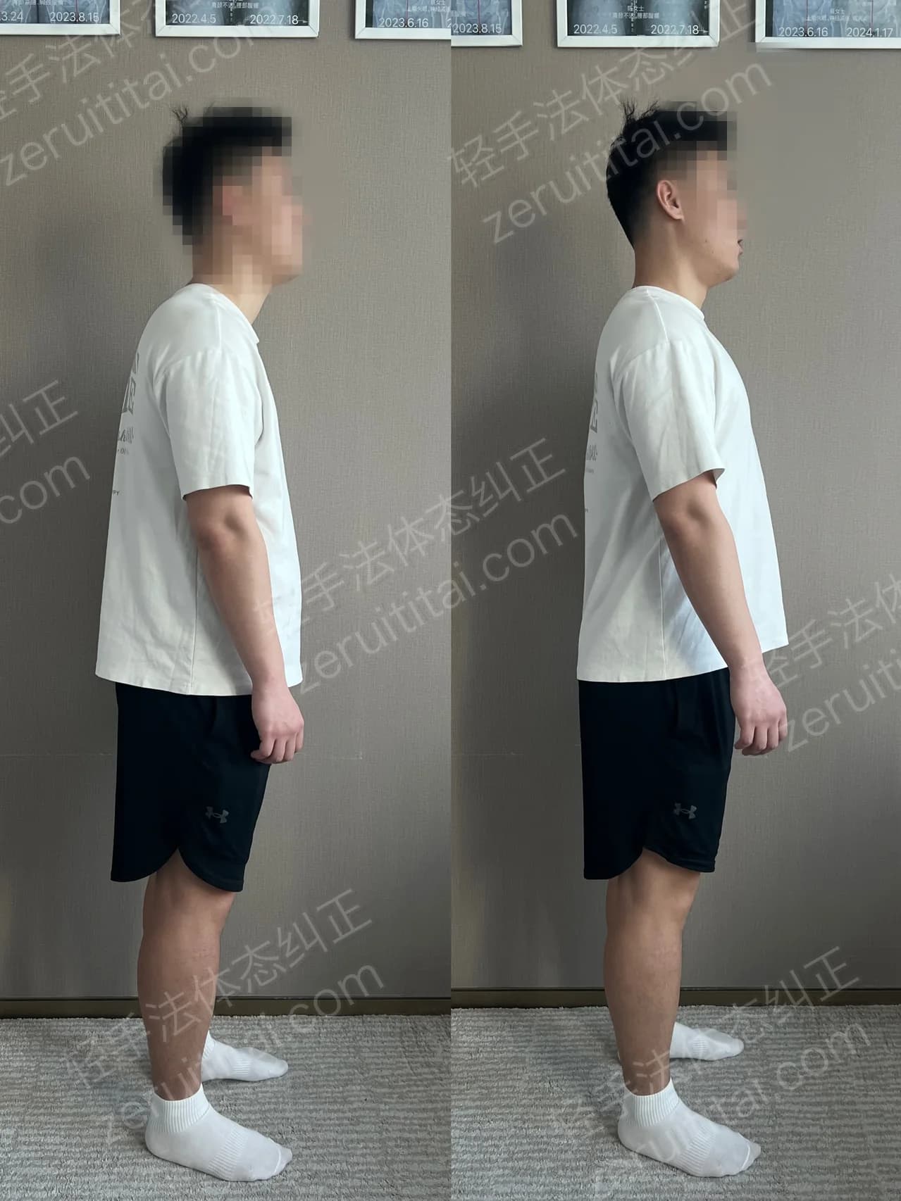 单次矫正案例对比 65