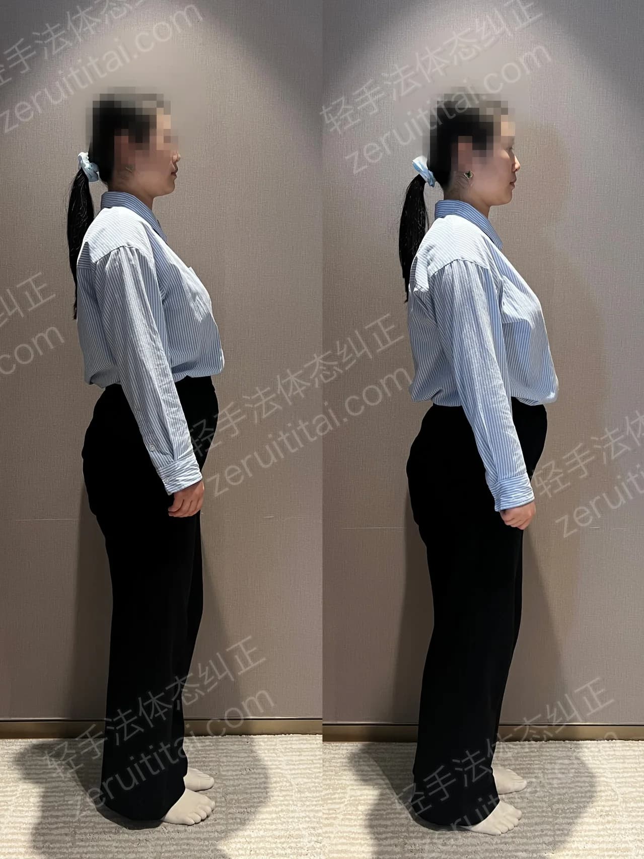 单次矫正案例对比 68