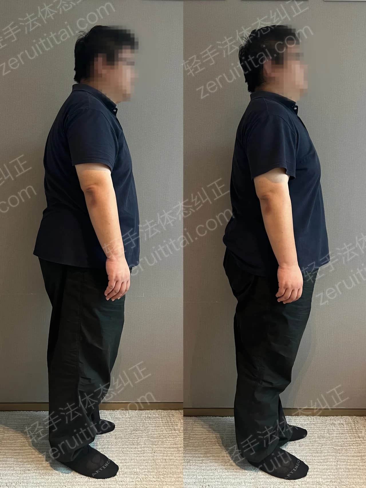 单次矫正案例对比 76