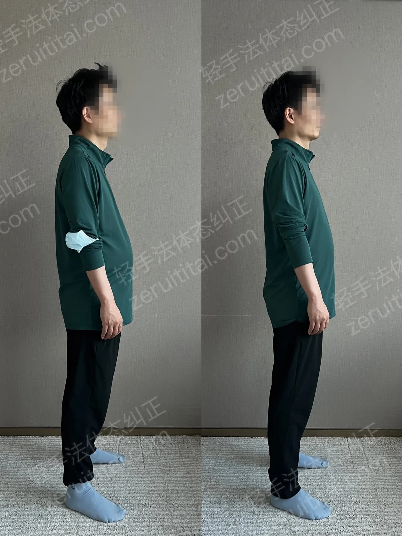 单次矫正案例对比 78