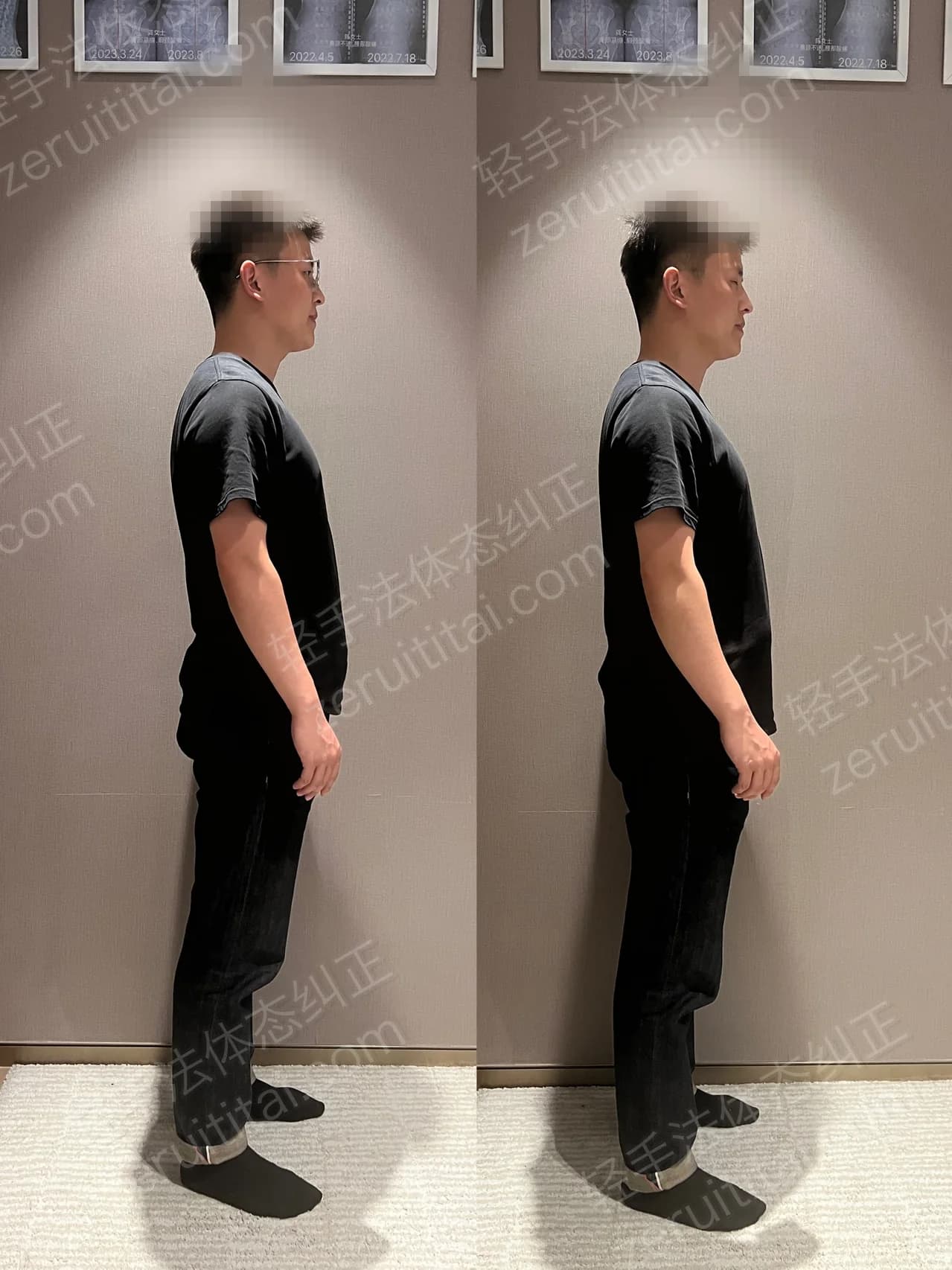 单次矫正案例对比 80
