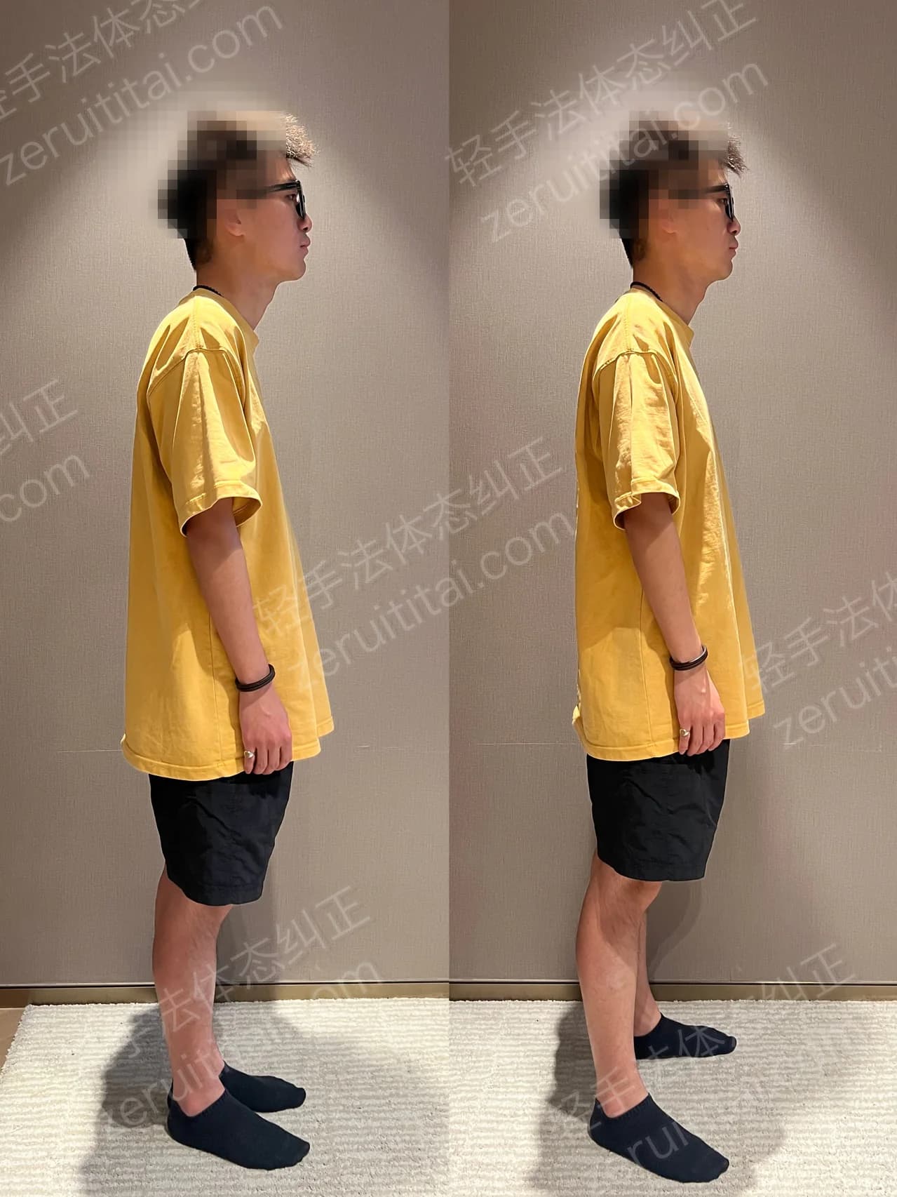 单次矫正案例对比 82