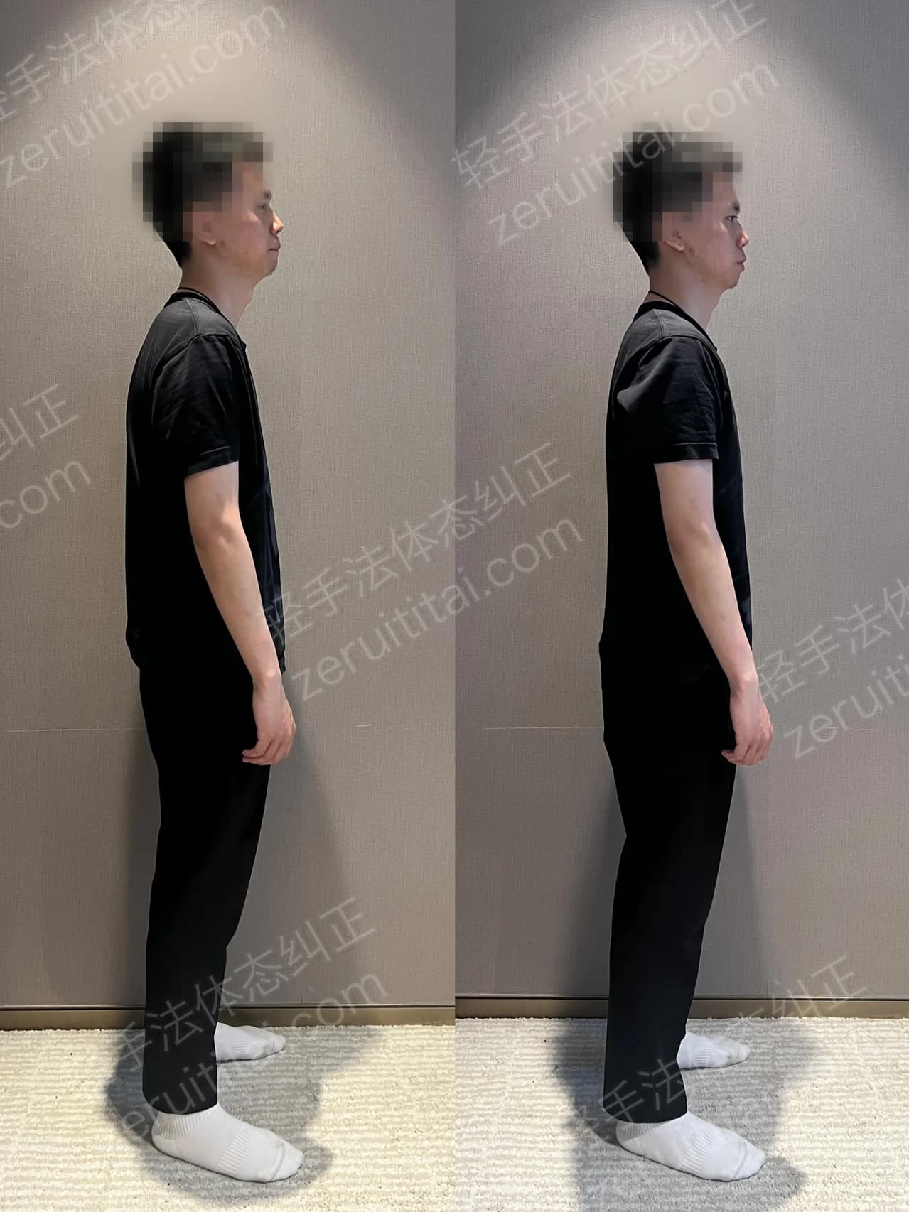 单次矫正案例对比 85