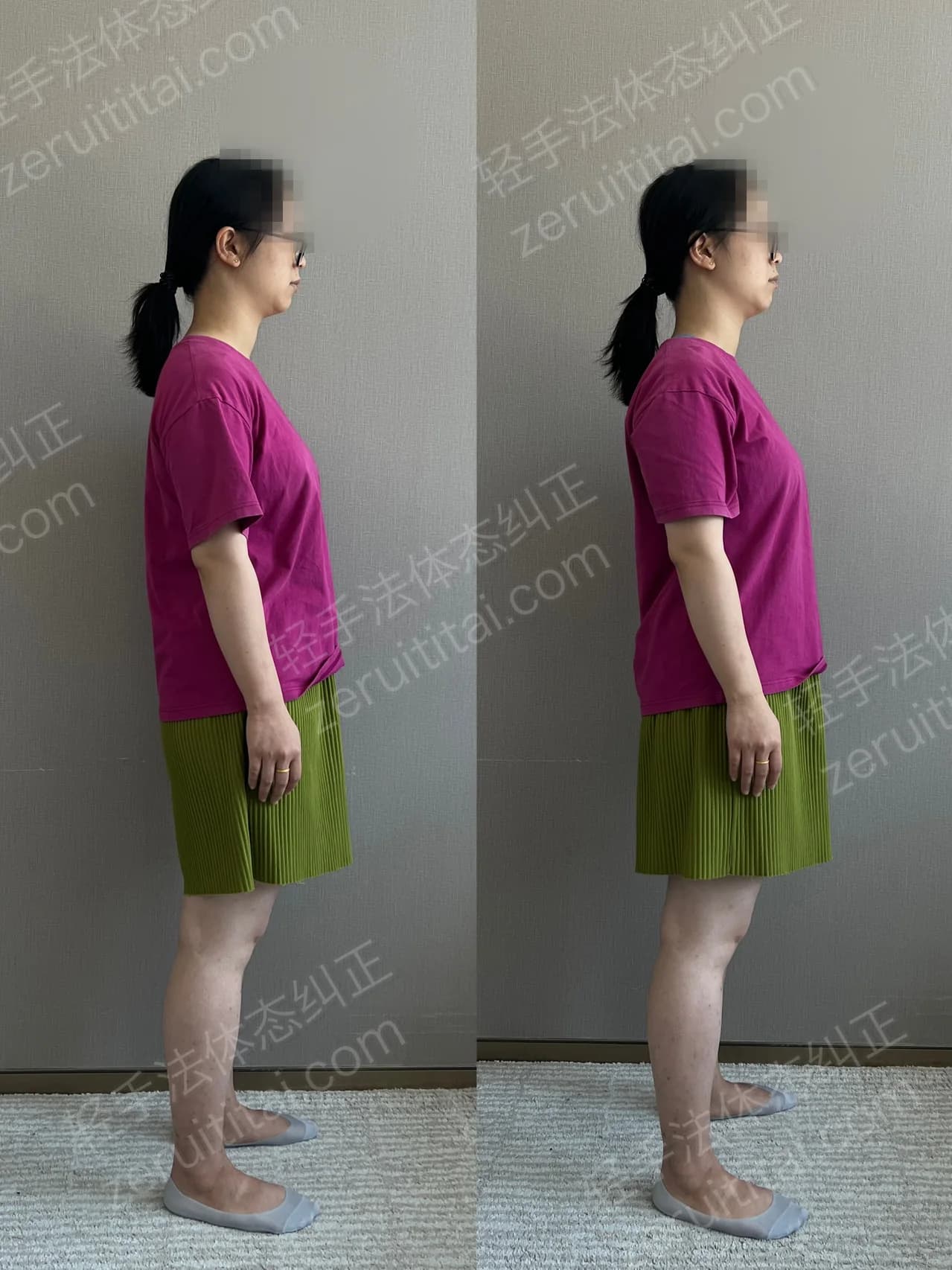 单次矫正案例对比 92
