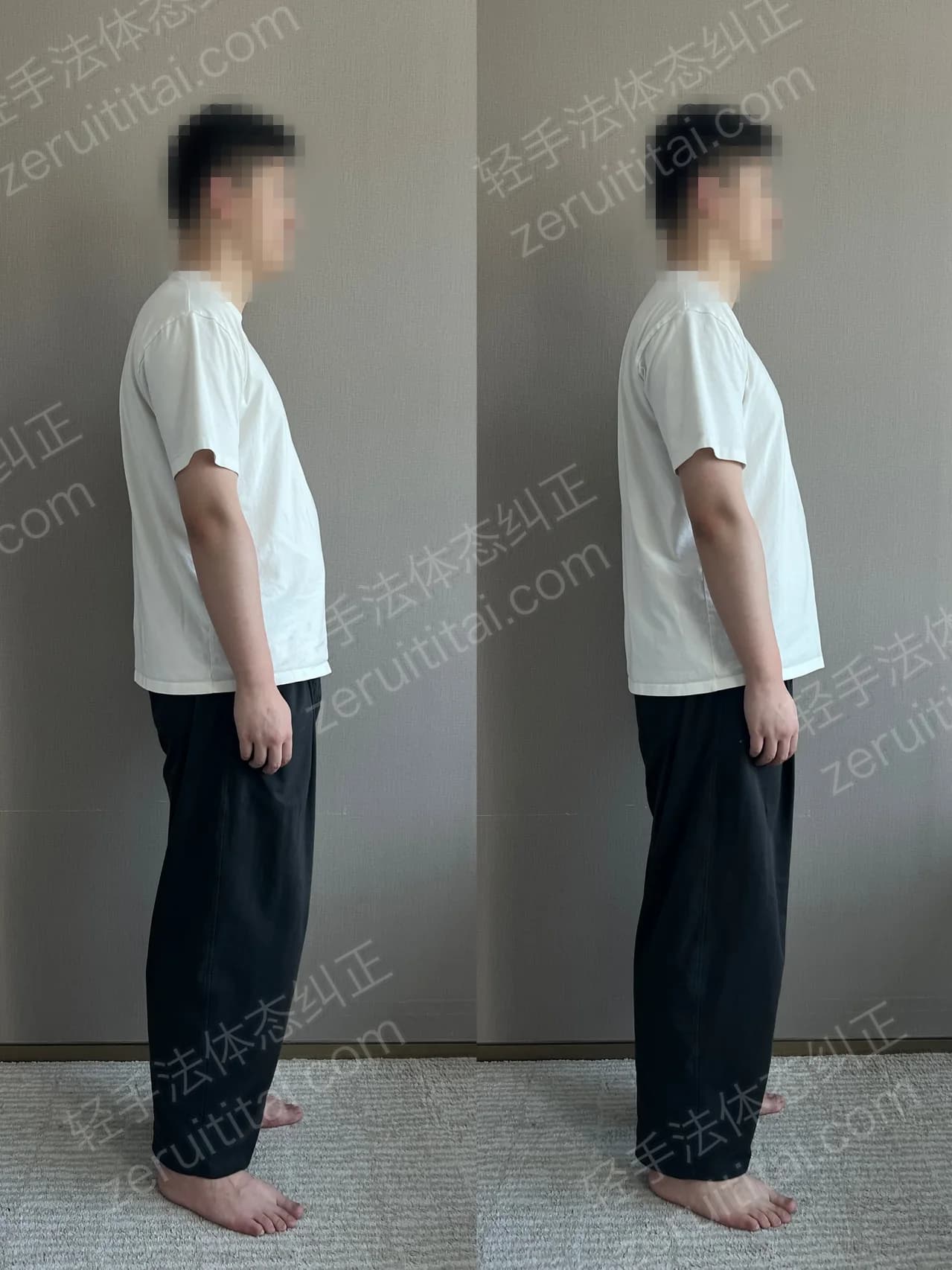 单次矫正案例对比 93