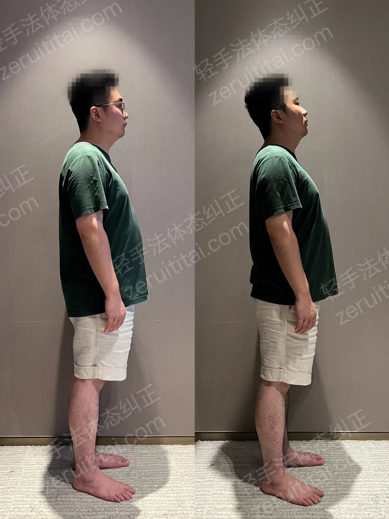 单次矫正案例对比 98