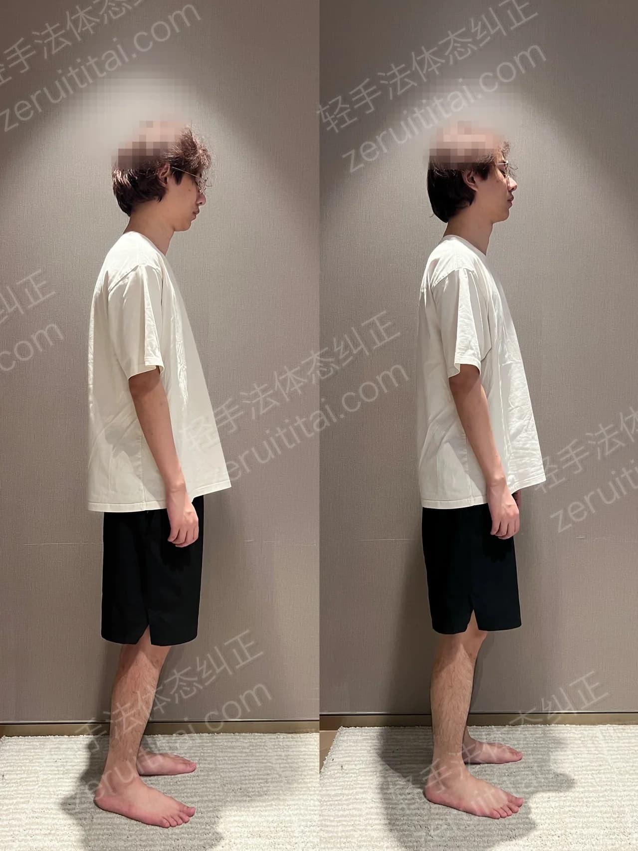 单次矫正案例对比 99