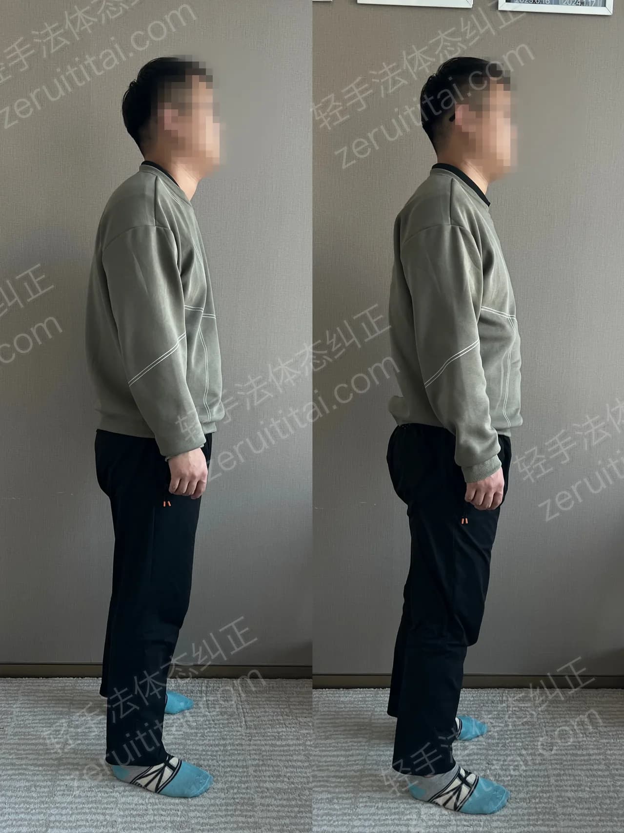 单次矫正案例对比 118