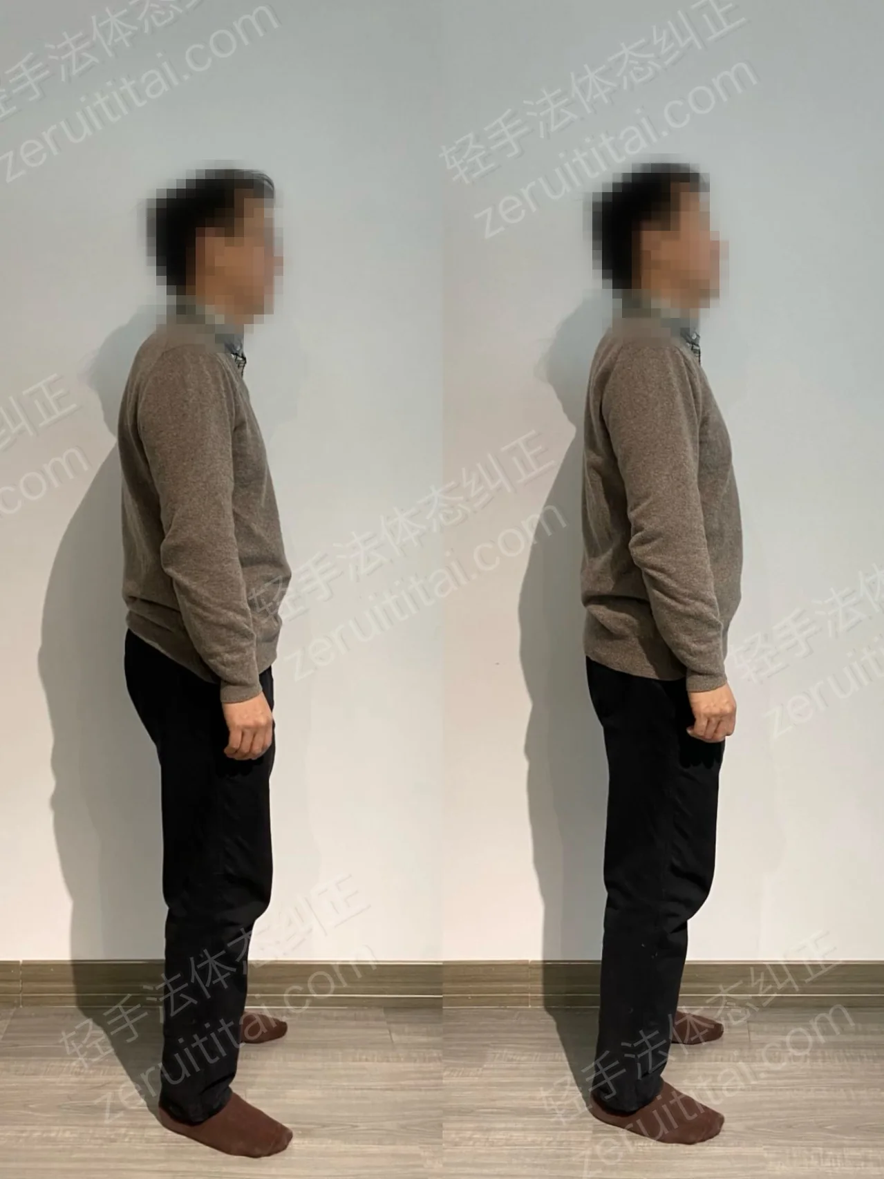 单次矫正案例对比 126