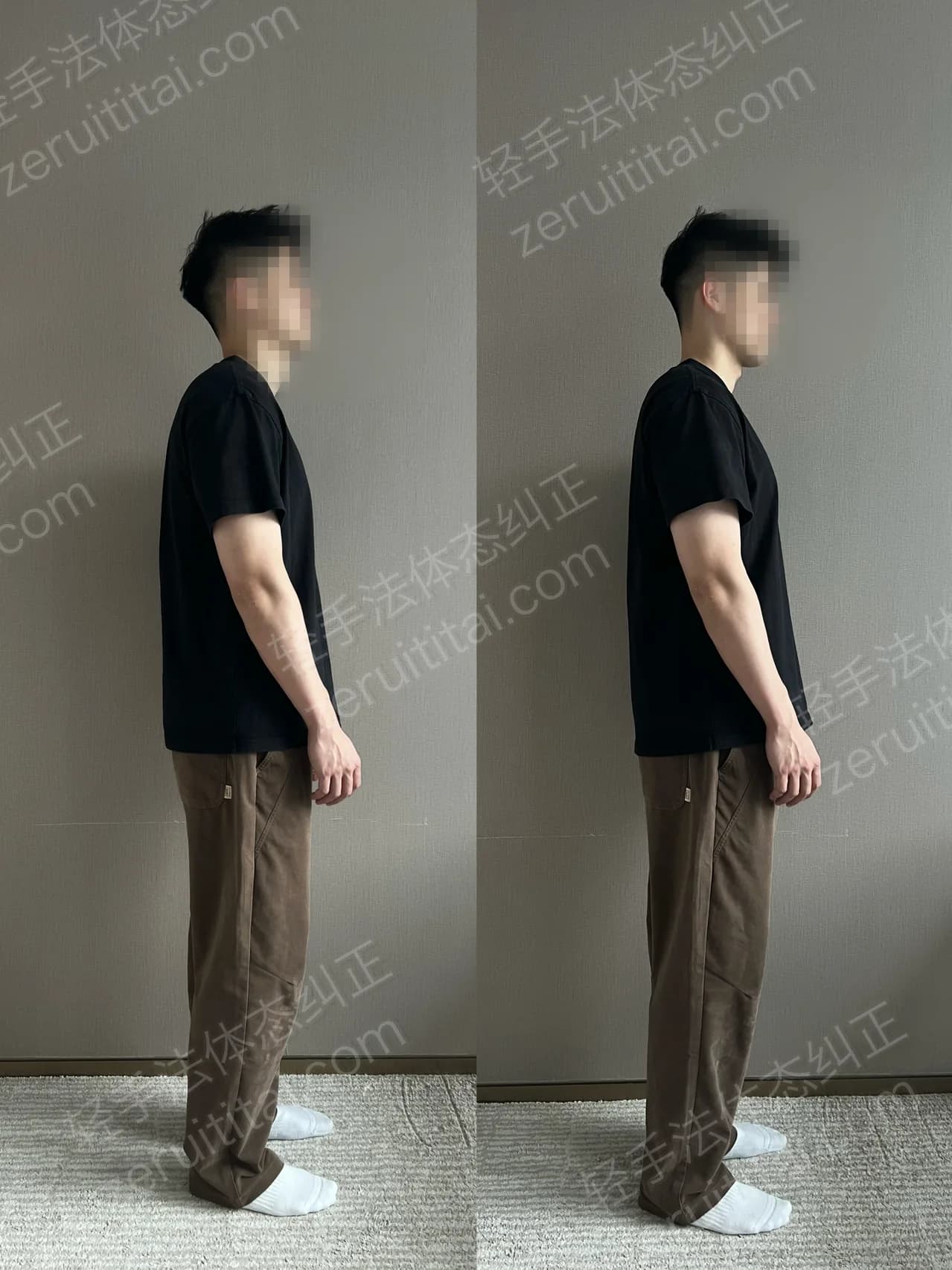 单次矫正案例对比 138