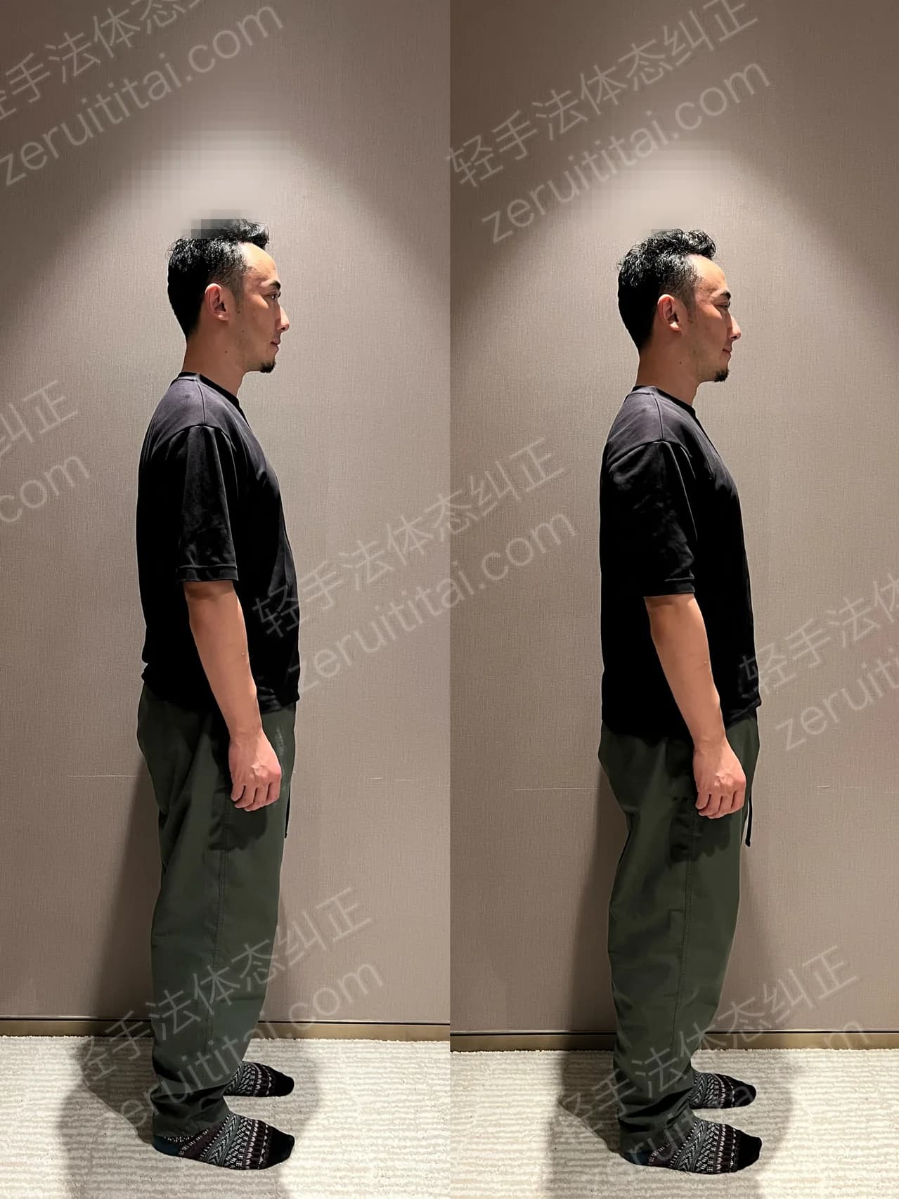 单次矫正案例对比 140