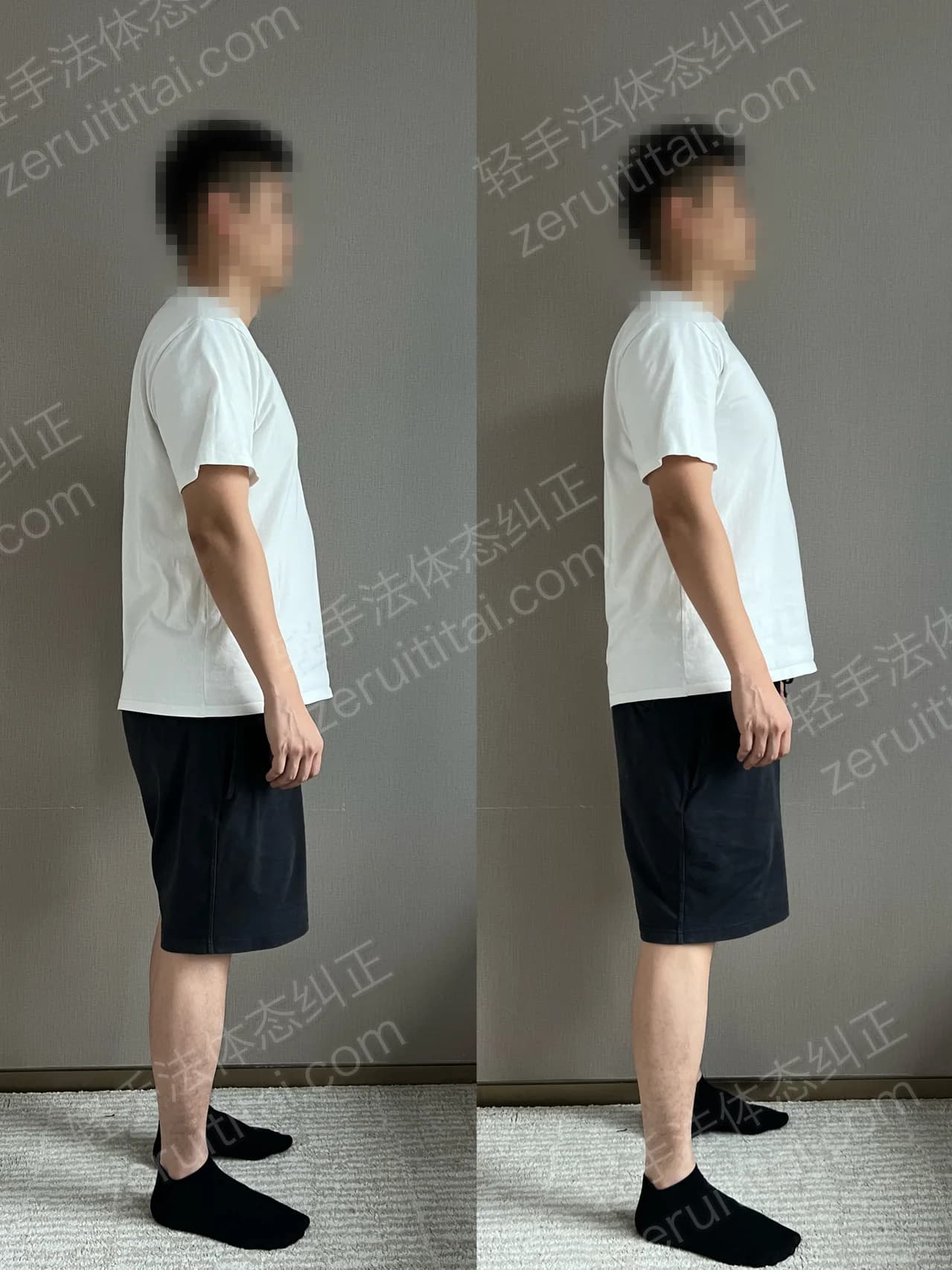 单次矫正案例对比 144