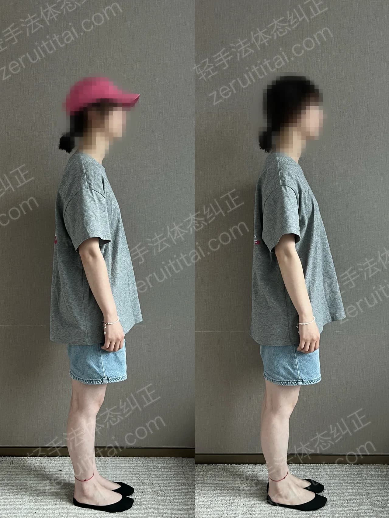 单次矫正案例对比 145