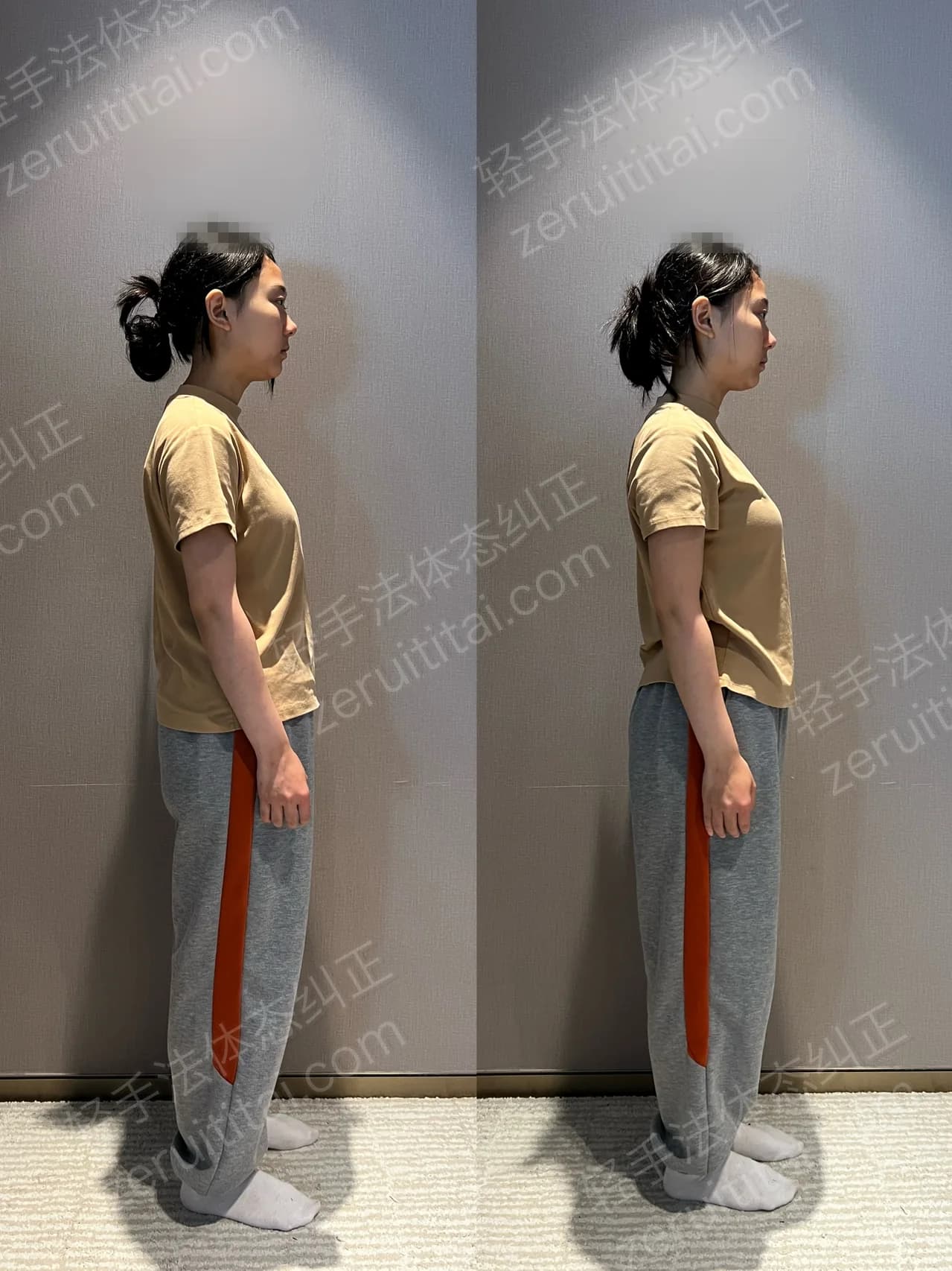 单次矫正案例对比 148