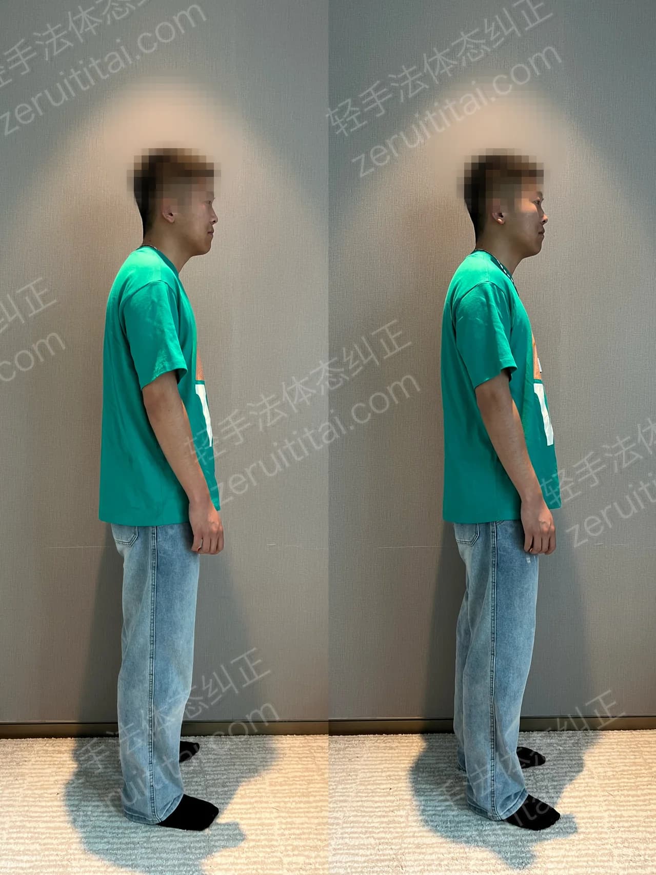 单次矫正案例对比 149