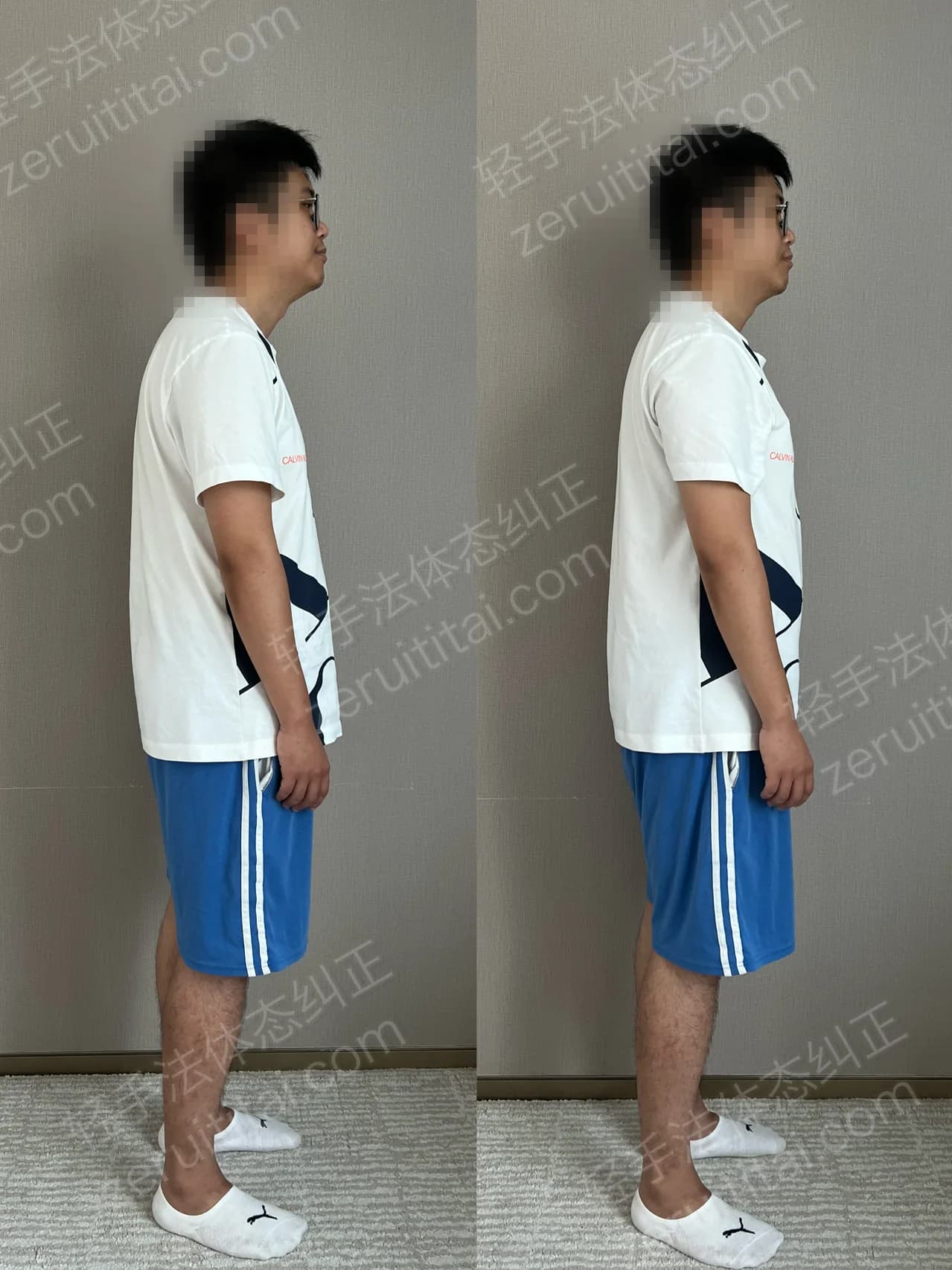 单次矫正案例对比 151