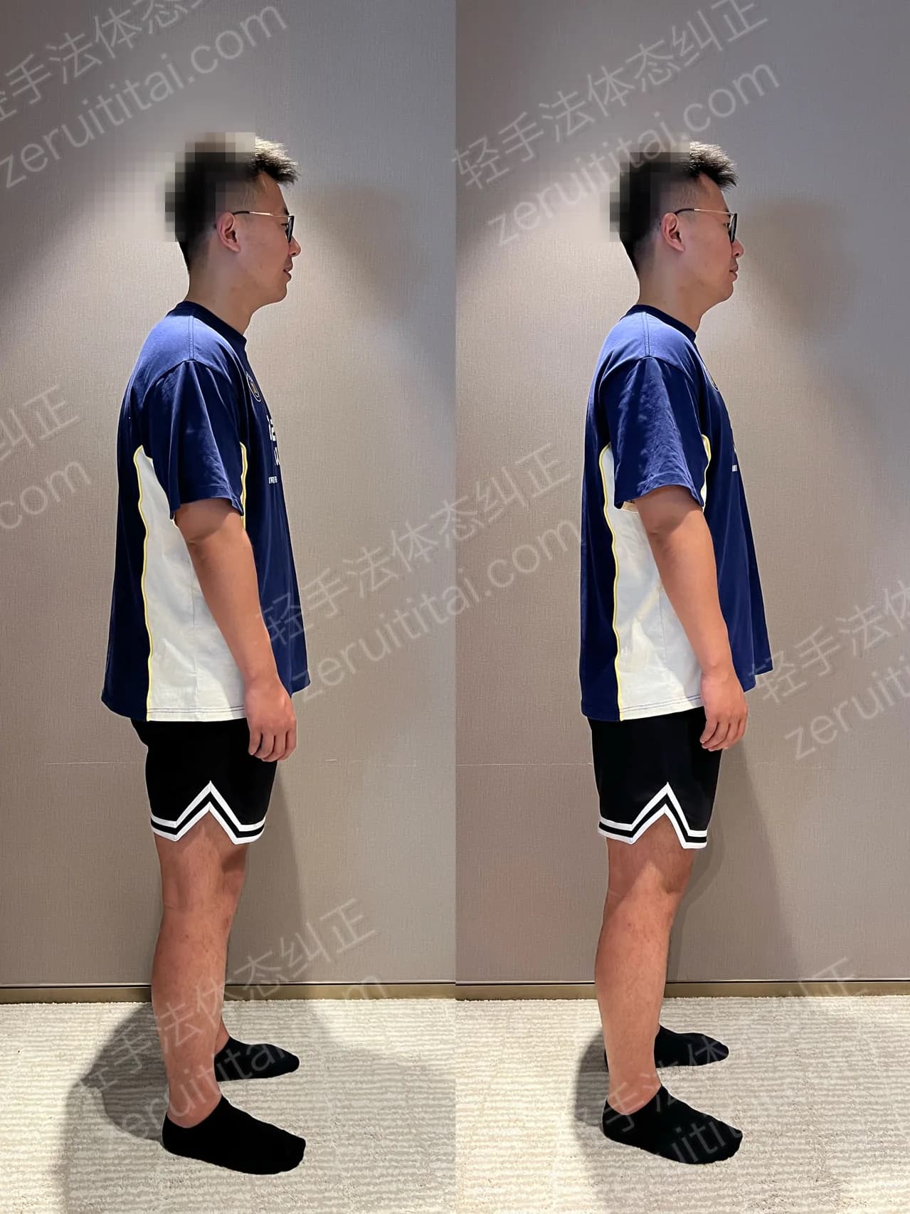 单次矫正案例对比 152
