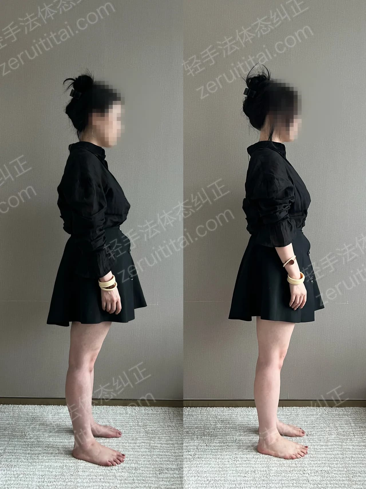 单次矫正案例对比 154