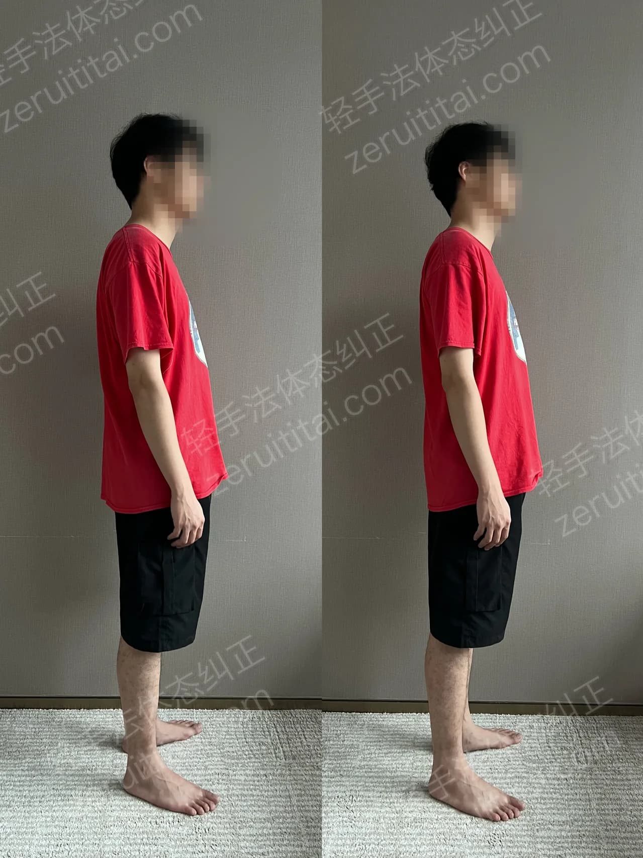 单次矫正案例对比 156