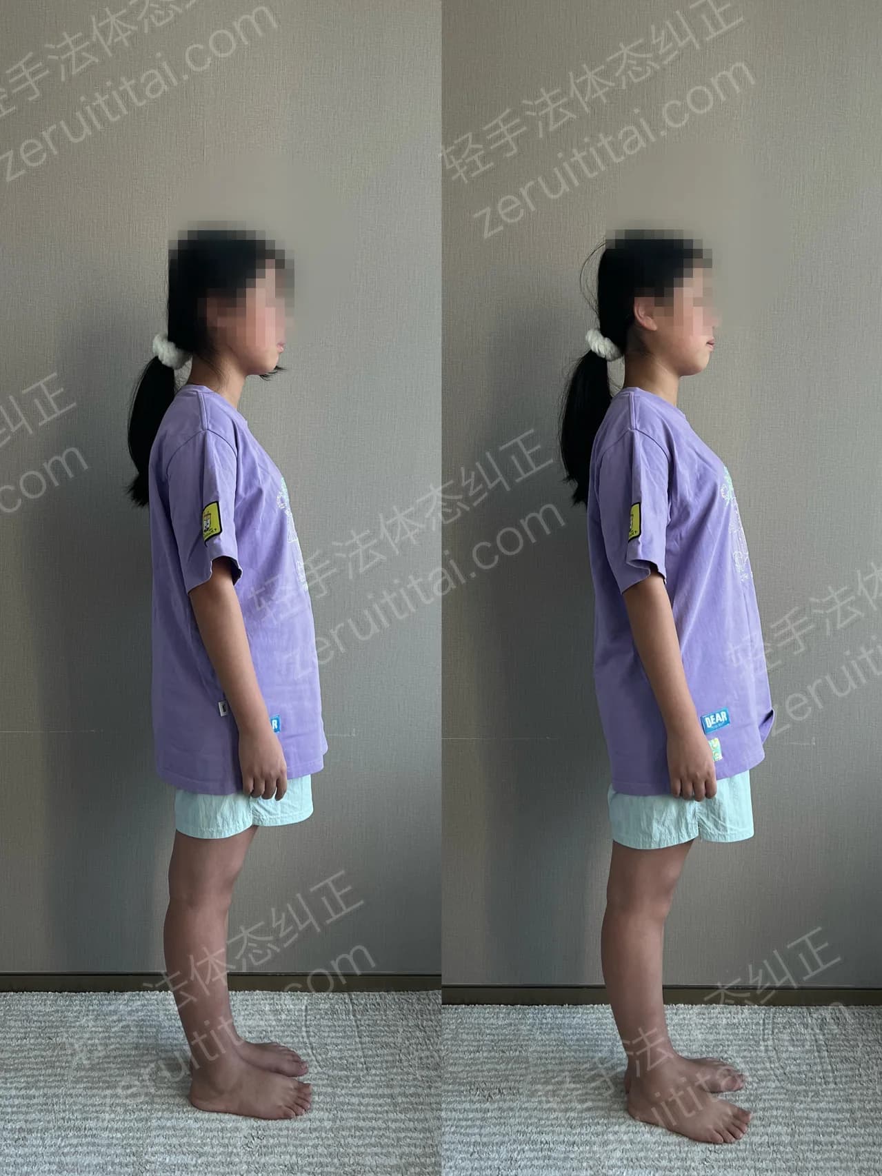单次矫正案例对比 159