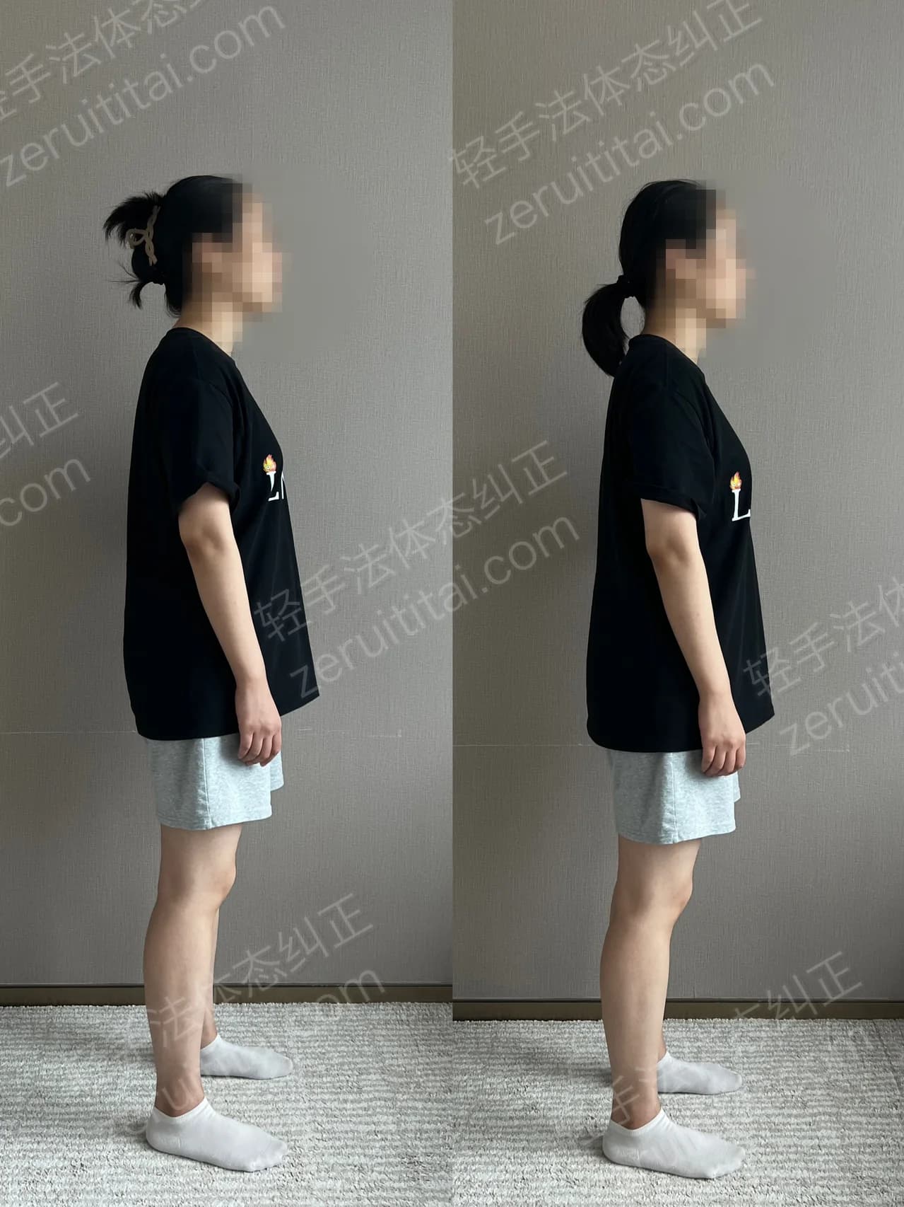 单次矫正案例对比 163