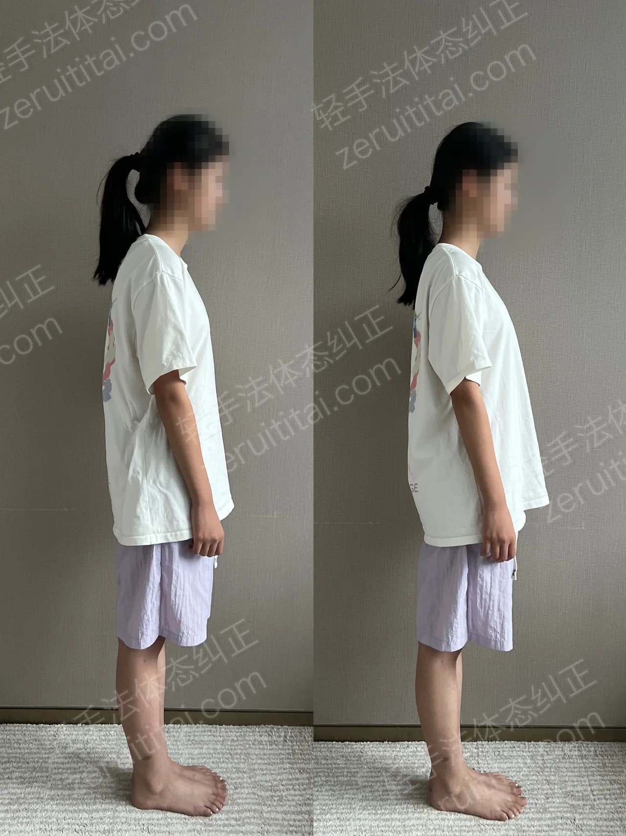 单次矫正案例对比 164