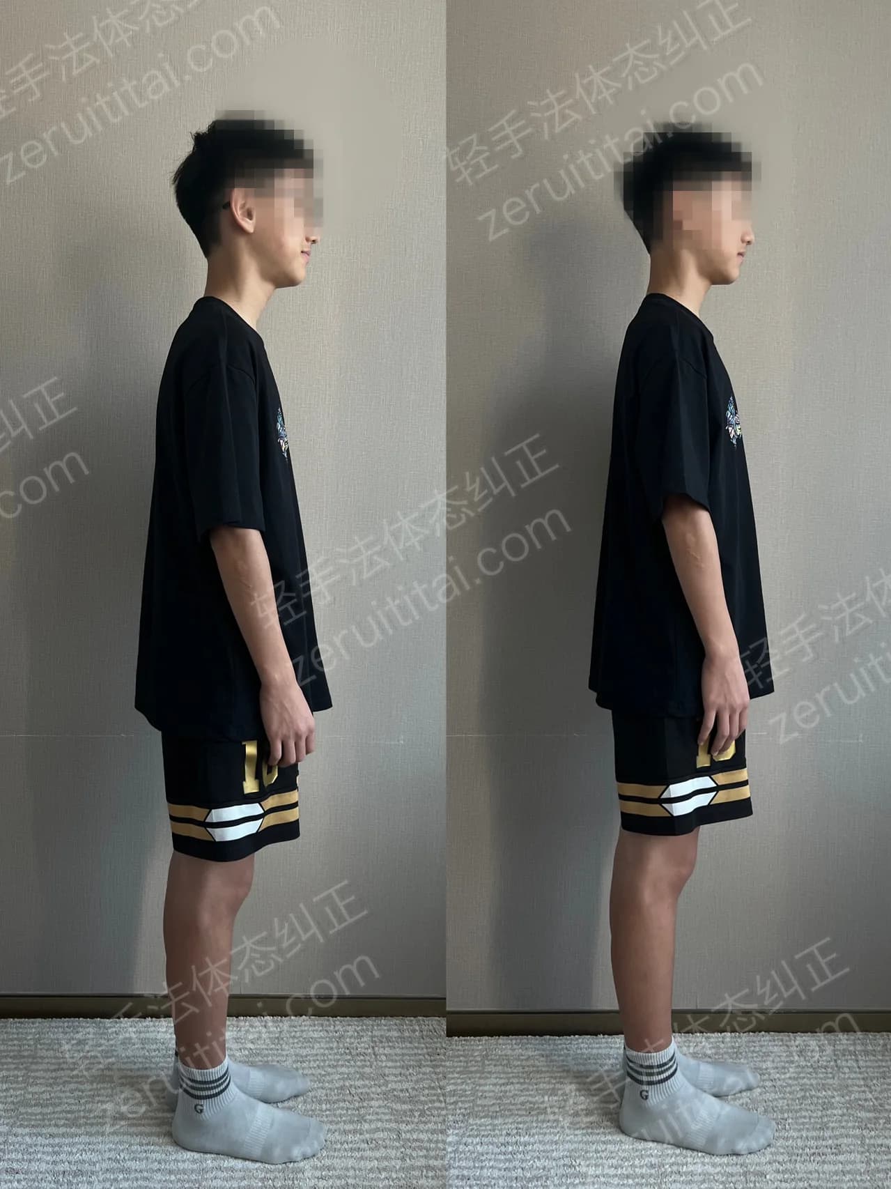 单次矫正案例对比 167