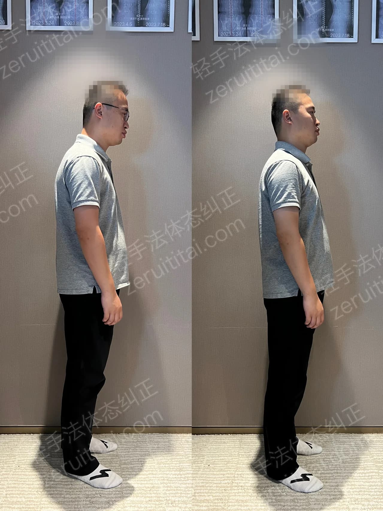单次矫正案例对比 171