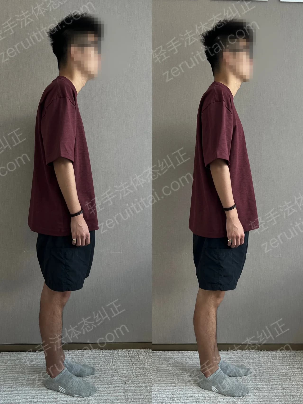 单次矫正案例对比 174