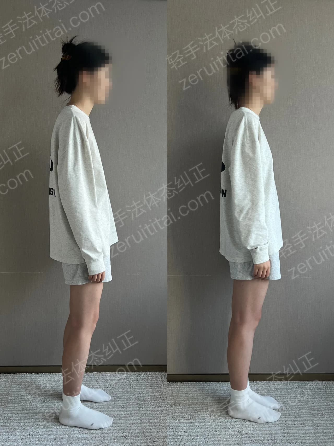 单次矫正案例对比 176
