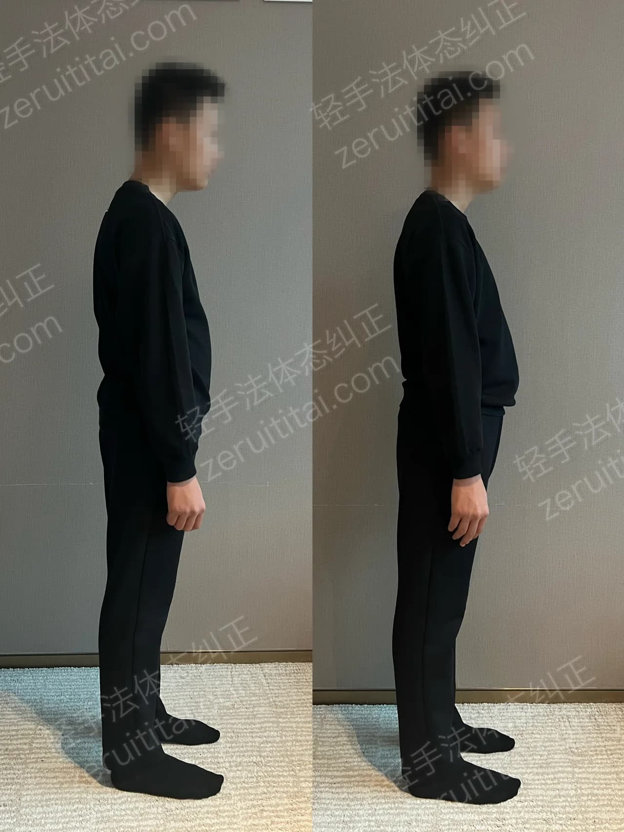 单次矫正案例对比 178