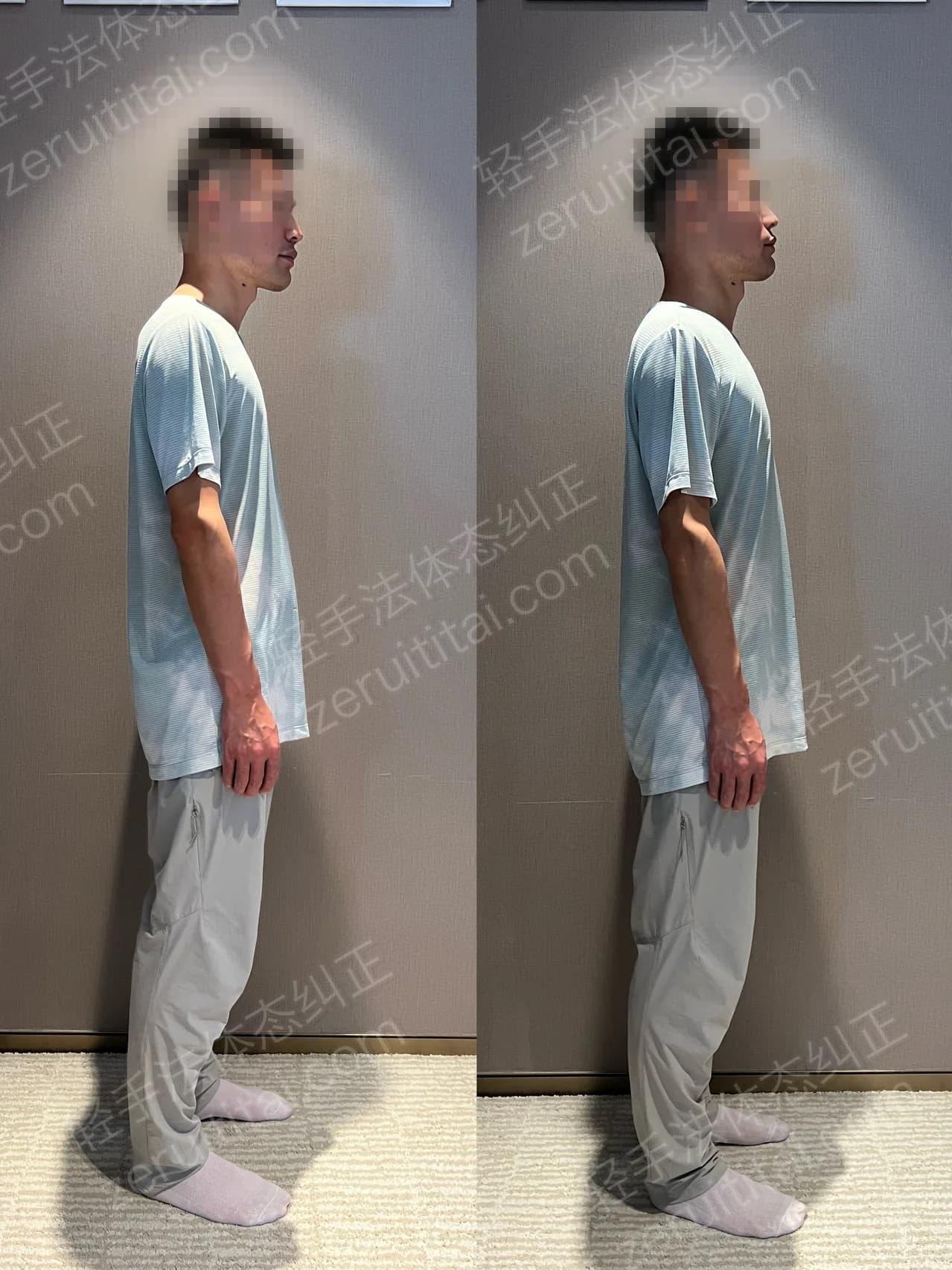 单次矫正案例对比 180