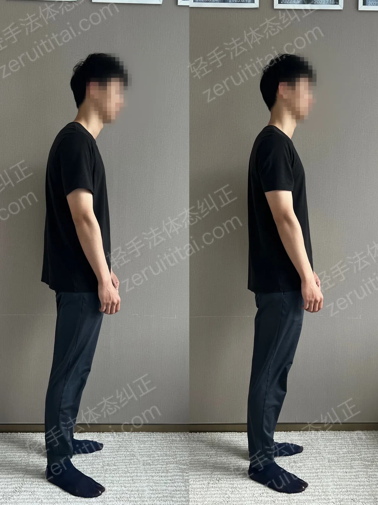 单次矫正案例对比 182
