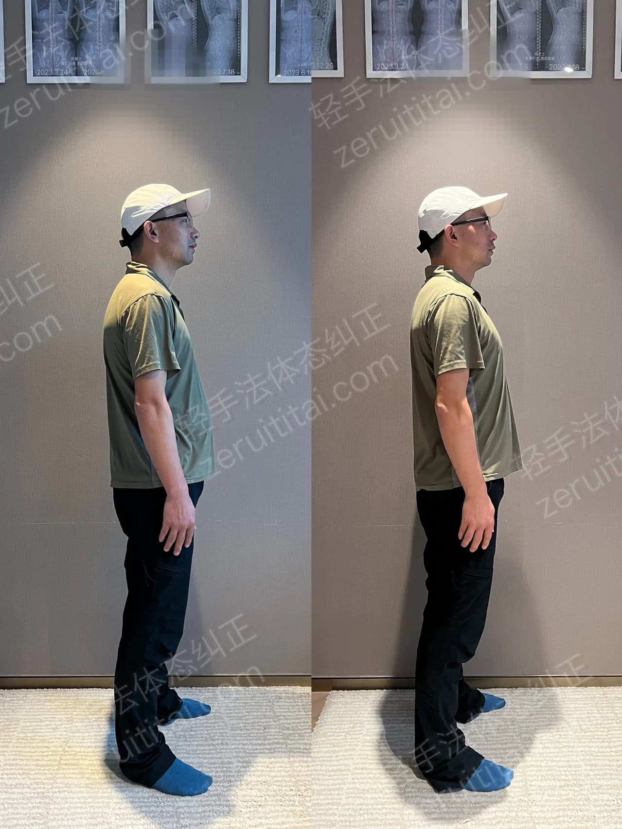 单次矫正案例对比 187