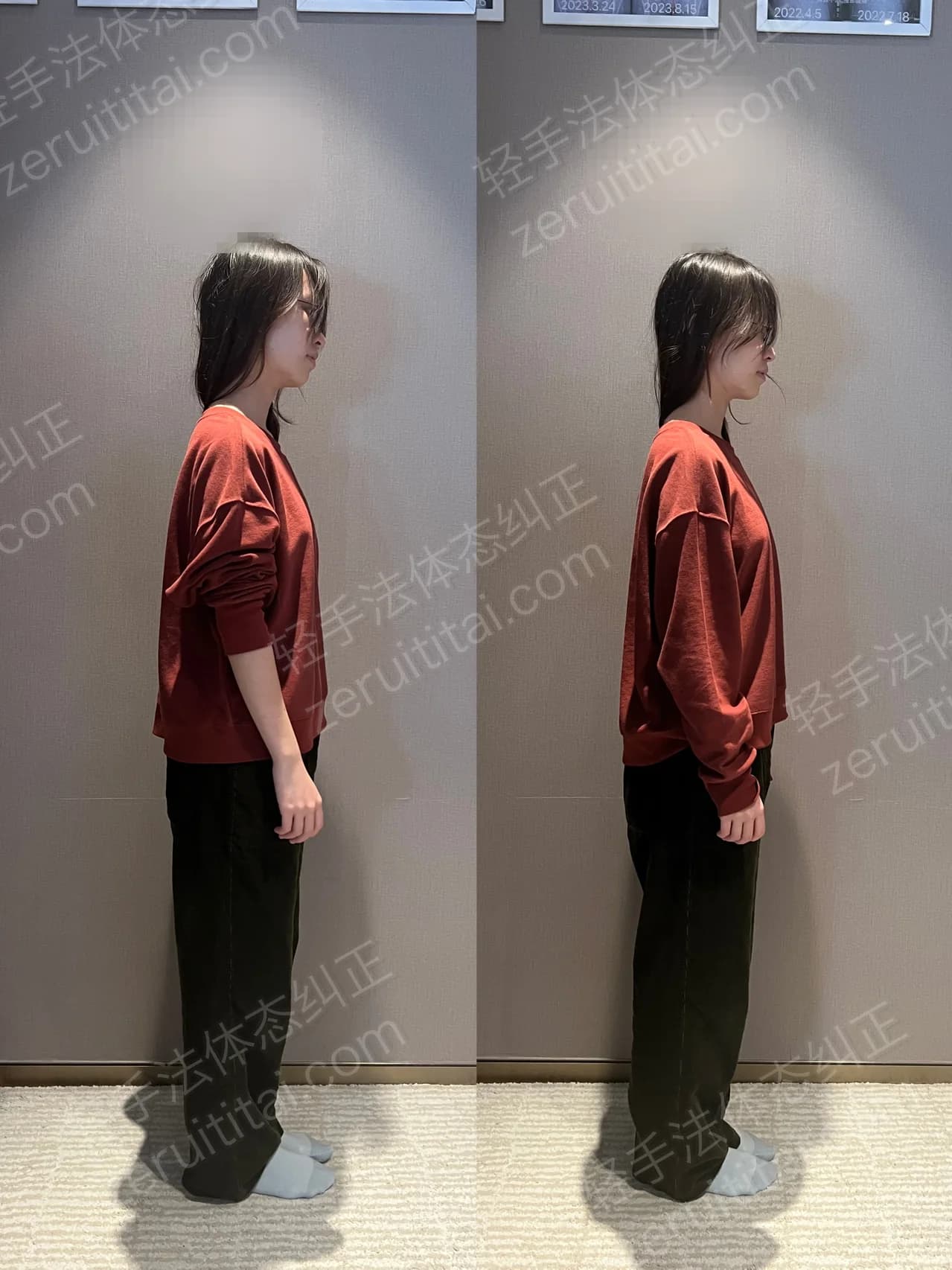 单次矫正案例对比 188