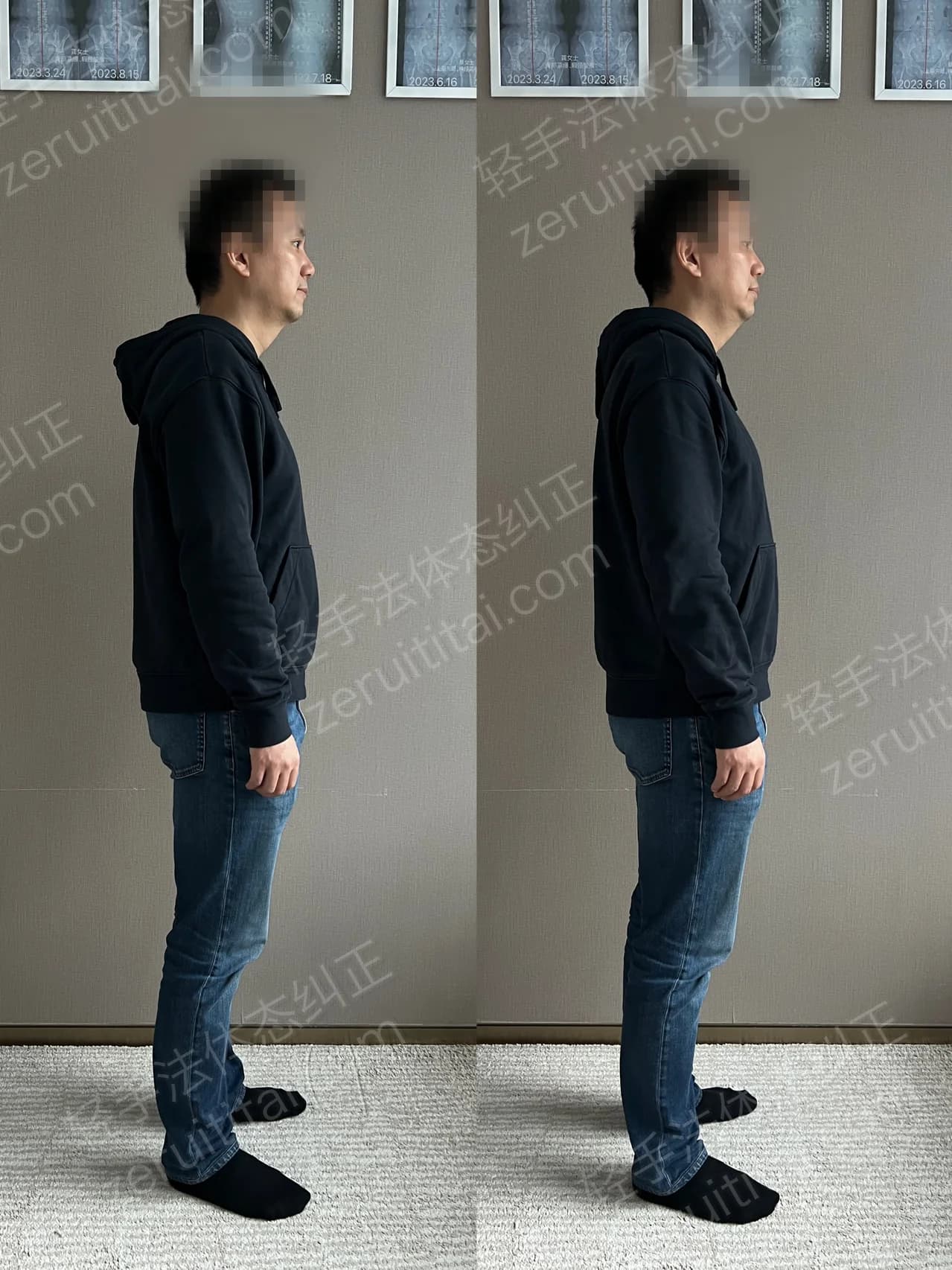 单次矫正案例对比 190