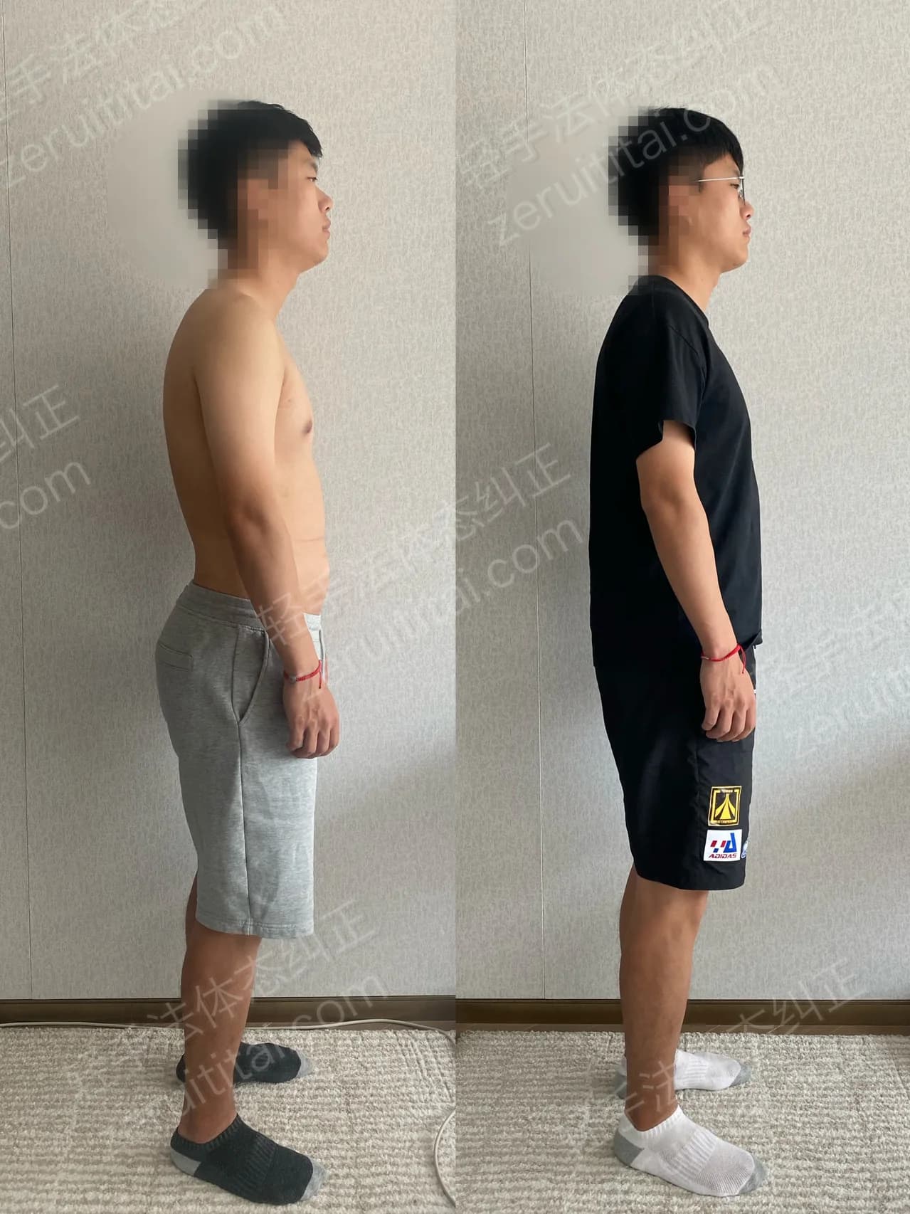 单次矫正案例对比 206